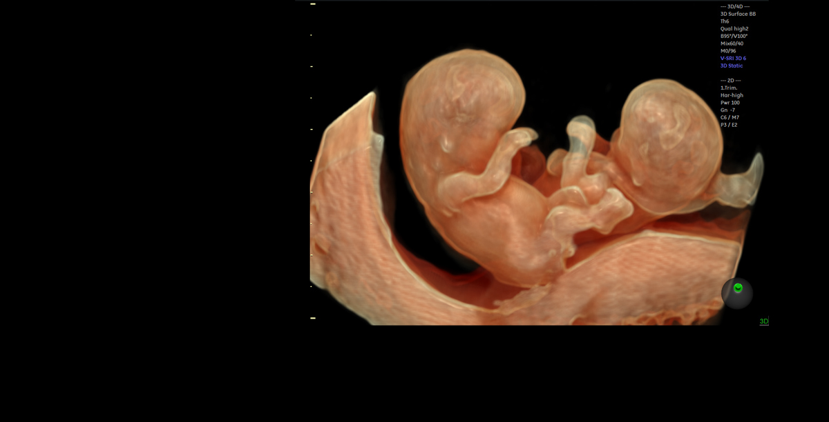 Ultrasound image 1 - Voluson 10E