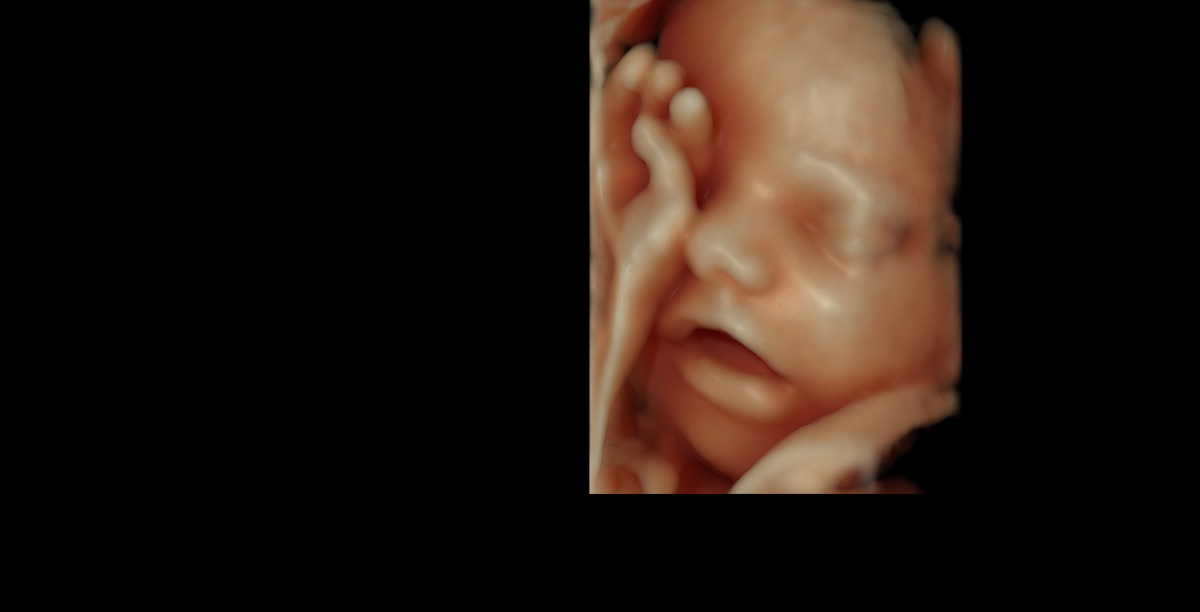 voluson e10 vsri fetal face