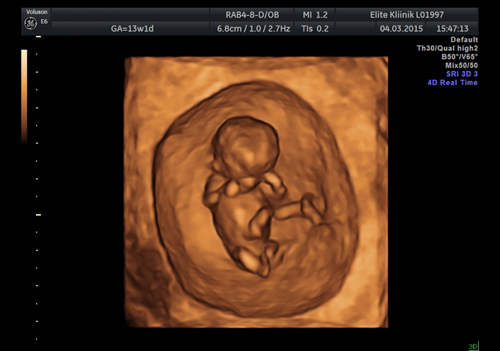 3DUH pilt 13. rasedusnädalal