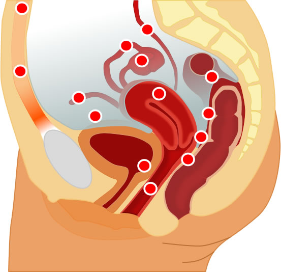 Endometrioosi levinuimad esinemiskohad