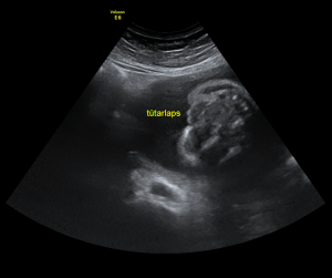 Ultraheliuuring 19-20 rasedusnädalal 2
