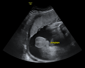 Ultraheliuuring 19-20 rasedusnädalal